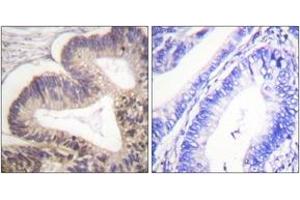 Immunohistochemistry analysis of paraffin-embedded human colon carcinoma, using PAK2 (Phospho-Ser20) Antibody. (PAK2 Antikörper  (pSer20))