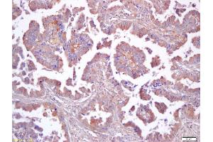 Formalin-fixed and paraffin embedded human lung carcinoma labeled with Anti-CD229/SLAMF3 Polyclonal Antibody, Unconjugated (ABIN741600) at 1:200 followed by conjugation to the secondary antibody and DAB staining (LY9 Antikörper  (AA 301-400))