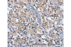 Immunohistochemistry of Human gastric cancer using GAS2 Polyclonal Antibody at dilution of 1:50 (GAS2 Antikörper)