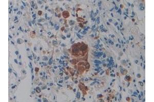 Detection of PTPRQ in Human Lung cancer Tissue using Polyclonal Antibody to Protein Tyrosine Phosphatase Receptor Type Q (PTPRQ) (PTPRQ Antikörper  (AA 36-294))