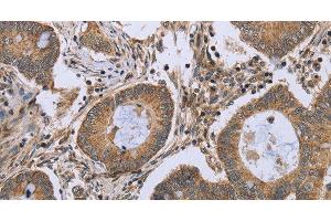 Immunohistochemistry of paraffin-embedded Human colon cancer using FKBP8 Polyclonal Antibody at dilution of 1:50 (FKBP8 Antikörper)