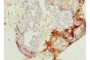 Immunohistochemistry of paraffin-embedded human breast cancer using ABIN7162990 at dilution of 1:100