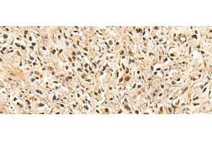 Immunohistochemistry of paraffin-embedded Human prost ate cancer tissue using PSMA3 Polyclonal Antibody at dilution of 1:50(x200) (PSMA3 Antikörper)