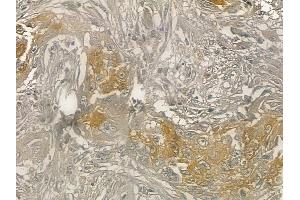 ABIN6262005 and ABIN6273249 at 1/100 staining human lung adenocarcinoma by IHC-P. (GMFG Antikörper  (Internal Region))