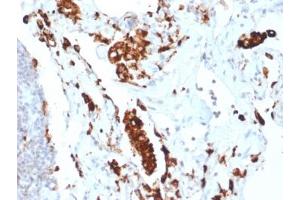 IHC testing of FFPE human lung adenocarcinoma with recombinant Napsin A antibody (clone NAPSA/1865R). (NAPSA Antikörper  (AA 189-299))