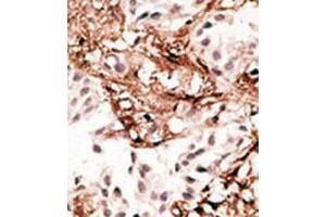 Immunohistochemical staining (Formalin-fixed paraffin-embedded sections) of human breast cancer tissue with MAP1LC3C polyclonal antibody  at 1:50-100 dilution. (LC3C Antikörper  (AA 1-30))