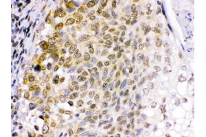 Anti- EME1 Picoband antibody,IHC(P) IHC(P): Human Lung Cancer Tissue (Crossover junction endonuclease EME1 (EME1) (AA 520-561), (C-Term) Antikörper)