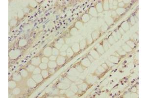 Immunohistochemistry of paraffin-embedded human colon cancer using ABIN7166731 at dilution of 1:100 (NSUN7 Antikörper  (AA 1-300))
