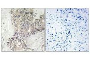 Immunohistochemistry analysis of paraffin-embedded human liver carcinoma tissue using B3GALTL antibody. (B3GALTL Antikörper  (C-Term))