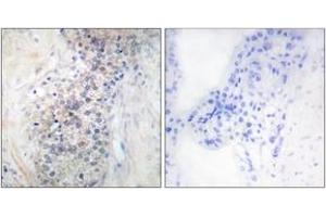 Immunohistochemistry analysis of paraffin-embedded human prostate carcinoma tissue, using LRAT Antibody. (LRAT Antikörper  (AA 111-160))