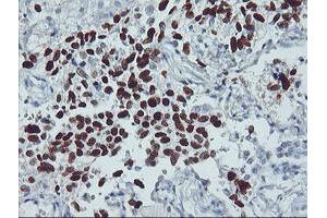 Immunohistochemistry (IHC) image for anti-Tumor Protein P53 (TP53) antibody (ABIN1499973)