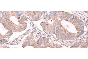 Immunohistochemistry of paraffin-embedded Human colorectal cancer tissue using ESM1 Polyclonal Antibody at dilution of 1:50(x200) (ESM1 Antikörper)