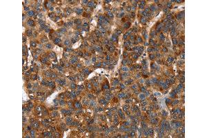 Immunohistochemistry of Human lung cancer using CACNB2 Polyclonal Antibody at dilution of 1:30 (CACNB2 Antikörper)