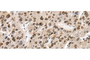 Immunohistochemistry of paraffin-embedded Human liver cancer using TUSC5 Polyclonal Antibody at dilution of 1/40 (TUSC5 Antikörper)