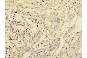 Immunohistochemistry of paraffin-embedded human pancreatic cancer using ABIN7153123 at dilution of 1:100 (FOSL2 Antikörper  (AA 1-326))