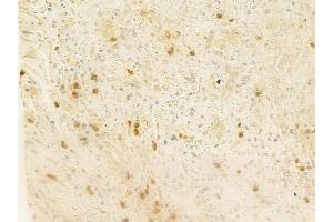 ABIN6261778 and ABIN6278766 at 1/100 staining human prostate carcinoma by IHC-P.