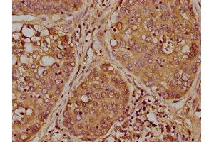 IHC image of ABIN7163597 diluted at 1:300 and staining in paraffin-embedded human liver cancer performed on a Leica BondTM system.