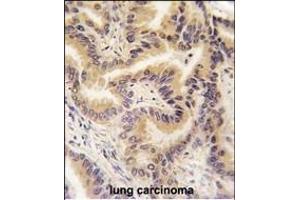Formalin-fixed and paraffin-embedded human lung carcinoma tissue reacted with RAF1 Antibody   , which was peroxidase-conjugated to the secondary antibody, followed by DAB staining. (RAF1 Antikörper  (AA 211-240))