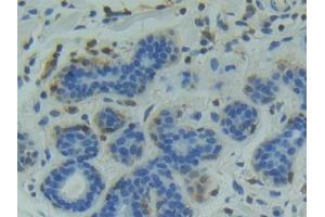 DAB staining on IHC-P; Samples: Human Breast cancer Tissue (GSK3 alpha Antikörper  (AA 115-409))