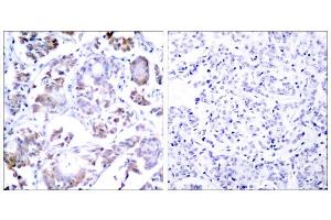 Immunohistochemical analysis of paraffin-embedded human breast carcinoma tissue, using NF-κB p65 (Ab-254) antibody (E021010). (NF-kB p65 Antikörper)