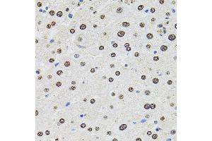 Immunohistochemistry of paraffin-embedded human liver damage using U2SURP antibody (ABIN6132839, ABIN6149759, ABIN6149760 and ABIN6220240) at dilution of 1:100 (40x lens). (SR140 Antikörper  (AA 705-1029))