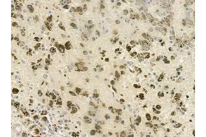 ABIN6260687 and ABIN6277042 at 1/100 staining human melanoma by IHC-P. (CDC45 Antikörper  (C-Term))