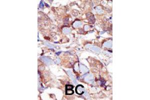 Immunohistochemistry (Formalin/PFA-fixed paraffin-embedded sections) of human breast carcinoma with MYLK3 polyclonal antibody , followed by peroxidase-conjugated secondary antibody and DAB staining. (MYLK3 Antikörper  (AA 40-69))