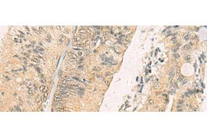 Immunohistochemistry of paraffin-embedded Human colorectal cancer tissue using THG1L Polyclonal Antibody at dilution of 1:70(x200) (THG1L Antikörper)