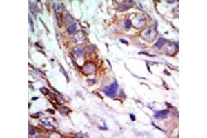 IHC analysis of FFPE human breast carcinoma tissue stained with the ERK5 antibody (MAPK7 Antikörper  (AA 776-805))