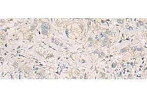Immunohistochemistry of paraffin-embedded Human liver cancer tissue using WDR37 Polyclonal Antibody at dilution of 1:50(x200) (WDR37 Antikörper)