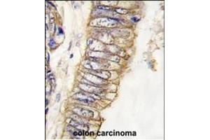 Formalin-fixed and paraffin-embedded human colon carcinoma tissue reacted with MET/HGFR Antibody (ABIN387741 and ABIN2837999) , which was peroxidase-conjugated to the secondary antibody, followed by DAB staining. (c-MET Antikörper  (Catalytic Domain))