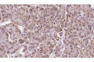 ABIN6273247 at 1/100 staining Human pancreas cancer tissue by IHC-P. (ARHGEF25/GEFT Antikörper  (Internal Region))