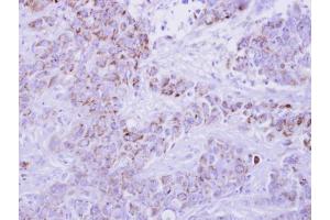 IHC-P Image I-309 antibody detects CCL1 protein at cytosol on human breast cancer by immunohistochemical analysis. (CCL1 Antikörper  (C-Term))