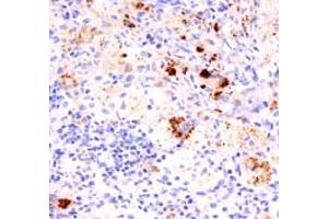 Formalin-fixed, paraffin-embedded human Erdheim Chester disease (also known as polyostotic sclerosing histiocytosis) stained with TNF alpha antibody (TNF706 + P/T2).