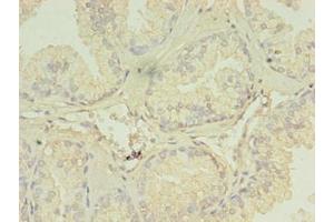 Immunohistochemistry of paraffin-embedded human prostate cancer using ABIN7151288 at dilution of 1:100 (TRIM9 Antikörper  (AA 1-550))