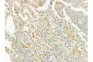 ABIN6261444 and ABIN6277566 at 1/100 staining human lung squamous cell carcinoma by IHC-P. (EEF2K Antikörper  (Internal Region))