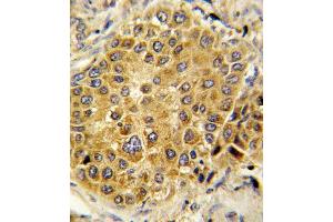 Formalin-fixed and paraffin-embedded human hepatocarcinoma reacted with PLG Antibody (C-term), which was peroxidase-conjugated to the secondary antibody, followed by DAB staining. (PLG Antikörper  (C-Term))