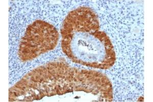 Formalin-fixed, paraffin-embedded human cervix stained with P16INK4a Recombinant Mouse Monoclonal Antibody (rCDKN2A/4845). (Rekombinanter CDKN2A Antikörper)