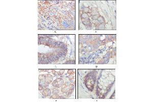 Immunohistochemical analysis of paraffin-embedded human lung squamous cell carcinoma (A), lung adenocarcinoma (B), colon carcinoma (C), breast carcinoma (D), normal sublingual gland (E), normal rectal (F), showing membrane localization with DAB staining using EphB3 mouse mAb.