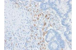 IHC testing of FFPE human colon carcinoma with DC-SIGN antibody (clone C209/1781). (DC-SIGN/CD209 Antikörper)