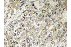 Immunohistochemistry analyzes of p70 S6K antibody in paraffin-embedded human breast carcinoma tissue. (RPS6KB1 Antikörper)