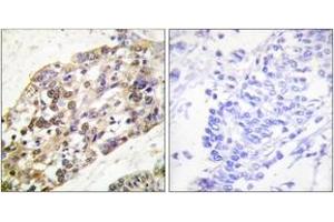 Immunohistochemistry analysis of paraffin-embedded human breast carcinoma tissue, using Histone H3 (Ab-28) Antibody. (Histone 3 Antikörper  (AA 13-62))