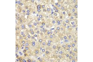 Immunohistochemistry of paraffin-embedded human liver cancer using HADH antibody at dilution of 1:100 (400x lens). (HADH Antikörper)