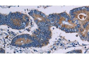 Immunohistochemistry of paraffin-embedded Human colon cancer tissue using ITK Polyclonal Antibody at dilution 1:50 (ITK Antikörper)