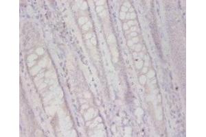 Immunohistochemistry of paraffin-embedded human colon cancer using ABIN7163507 at dilution of 1:50 (FUCA2 Antikörper  (AA 29-465))