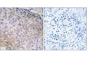 Immunohistochemistry analysis of paraffin-embedded human breast carcinoma tissue, using NOX3 Antibody. (NOX3 Antikörper  (AA 287-336))