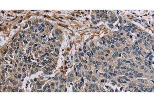 Immunohistochemistry of paraffin-embedded Human lung cancer tissue using PNPT1 Polyclonal Antibody at dilution 1:40 (PNPT1 Antikörper)