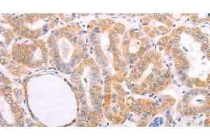Immunohistochemistry of paraffin-embedded Human thyroid cancer tissue using pVHL Polyclonal Antibody at dilution 1:40 (VHL Antikörper)