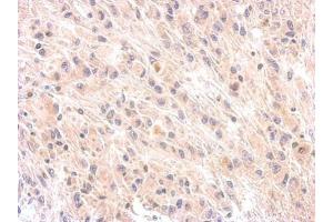IHC-P Image Immunohistochemical analysis of paraffin-embedded U373 xenograft, using Factor H, antibody at 1:200 dilution. (Complement Factor H Antikörper)