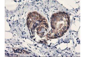 Immunohistochemical staining of paraffin-embedded Adenocarcinoma of Human breast tissue using anti-PDE4B mouse monoclonal antibody.